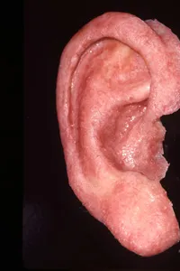 Photo of prosthetic ear