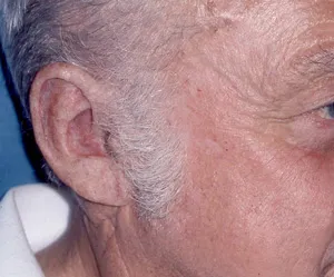 Photo of prosthetic ear on person