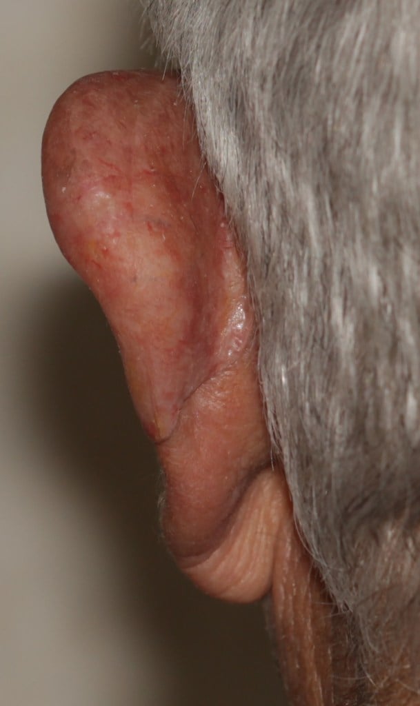 After a partial ear prosthesis