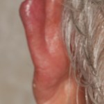 Before a partial ear prosthesis