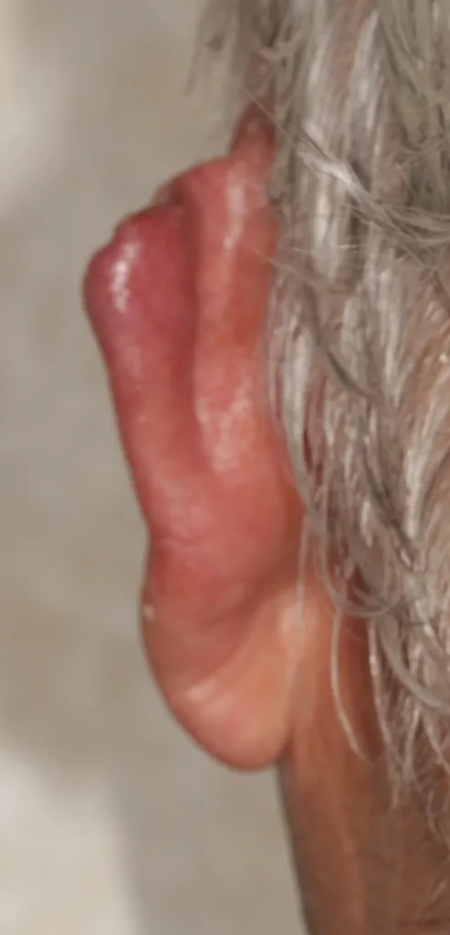 Before a partial ear prosthesis