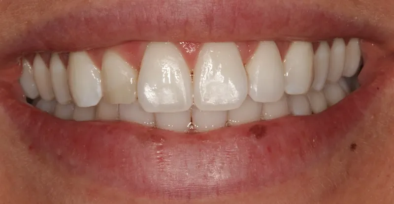 After treating decalcifications on the teeth