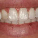 After treating decalcifications on the teeth