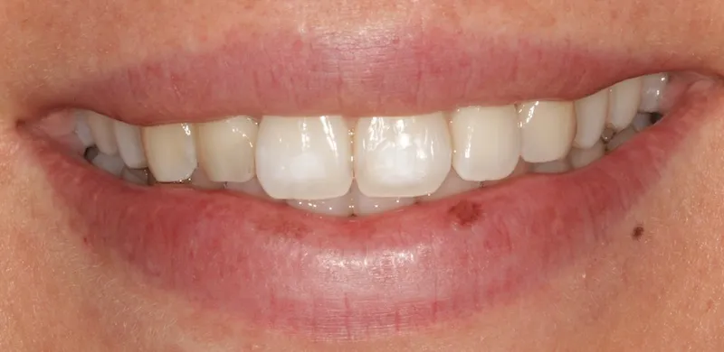 Before treating decalcifications on the teeth