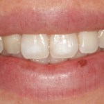 Before treating decalcifications on the teeth