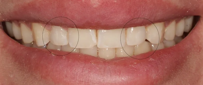After peg lateral direct composite bonding