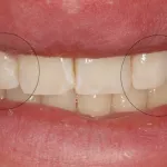After peg lateral direct composite bonding