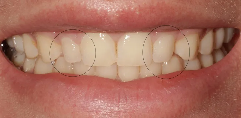 Before peg lateral direct composite bonding