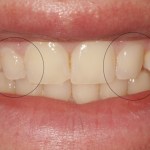 Before peg lateral direct composite bonding