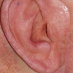 After an ear prosthesis