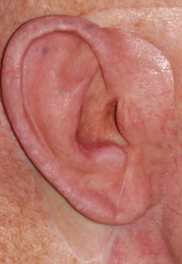 After an ear prosthesis