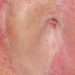 Before an ear prosthesis