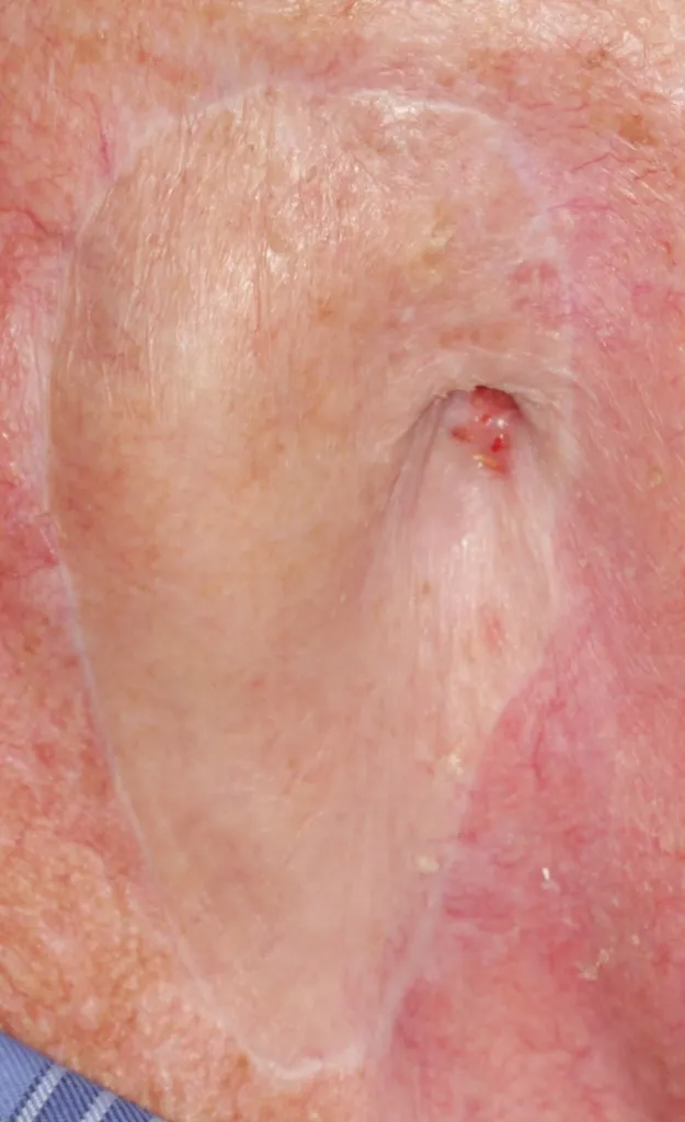 Before an ear prosthesis