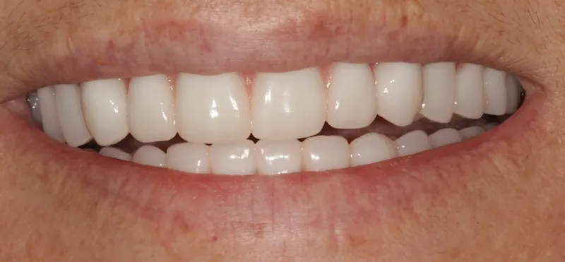After a fixed hybrid prosthesis