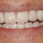 After a fixed hybrid prosthesis