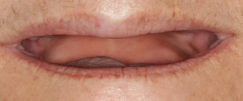 Before a fixed hybrid prosthesis