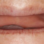 Before a fixed hybrid prosthesis