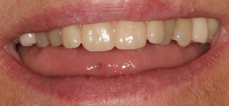After a removable partial denture