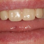 After a removable partial denture