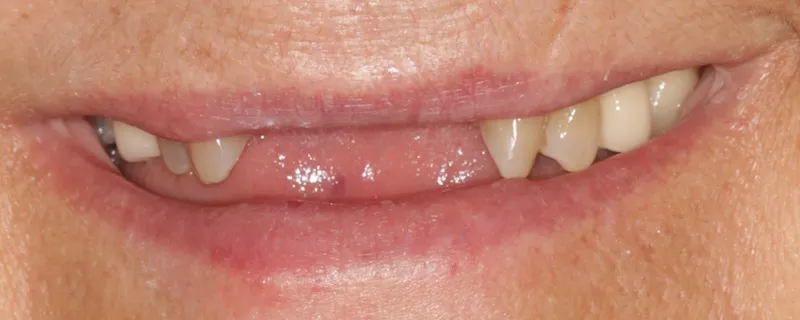Before a removable partial denture