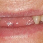 Before a removable partial denture