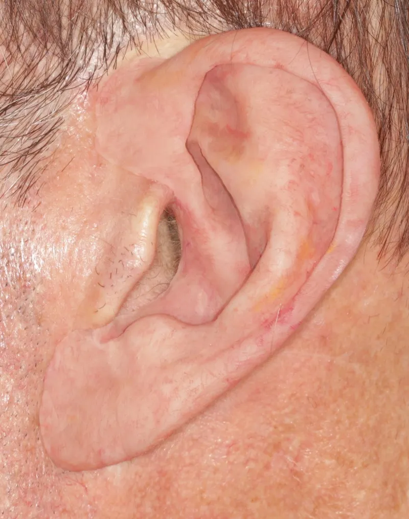 After an ear prosthesis