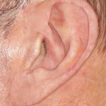 After an ear prosthesis