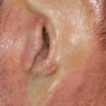Before an ear prosthesis