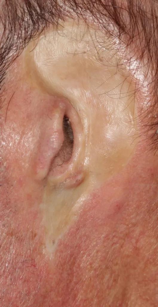 Before an ear prosthesis