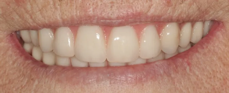 After a fixed hybrid prosthesis