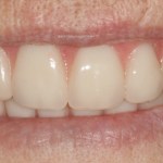 After a fixed hybrid prosthesis