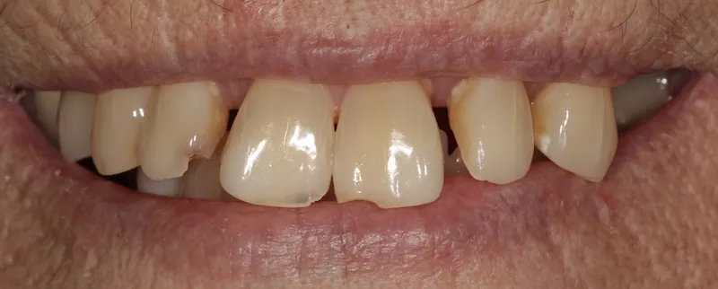 Before a fixed hybrid prosthesis