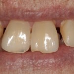 Before a fixed hybrid prosthesis