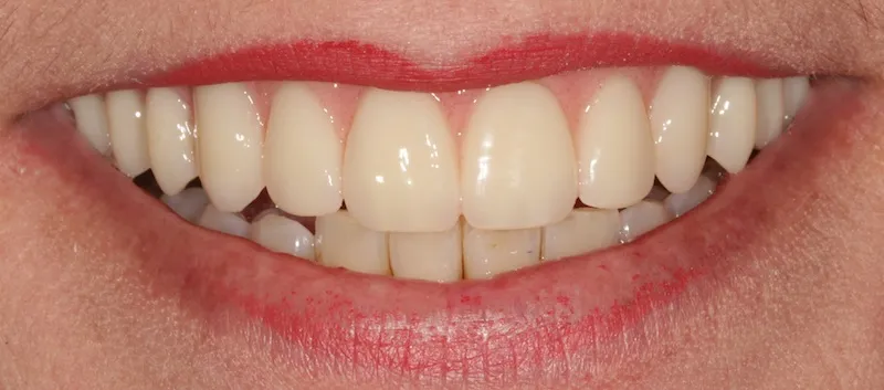 After a fixed hybrid prosthesis on implants
