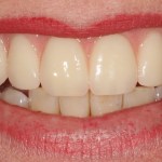 After a fixed hybrid prosthesis on implants