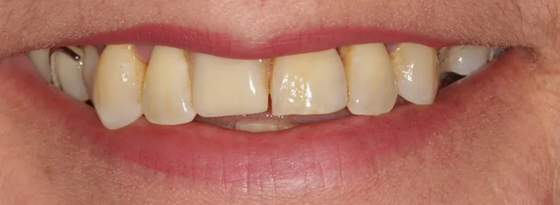 Before a fixed hybrid prosthesis on implants