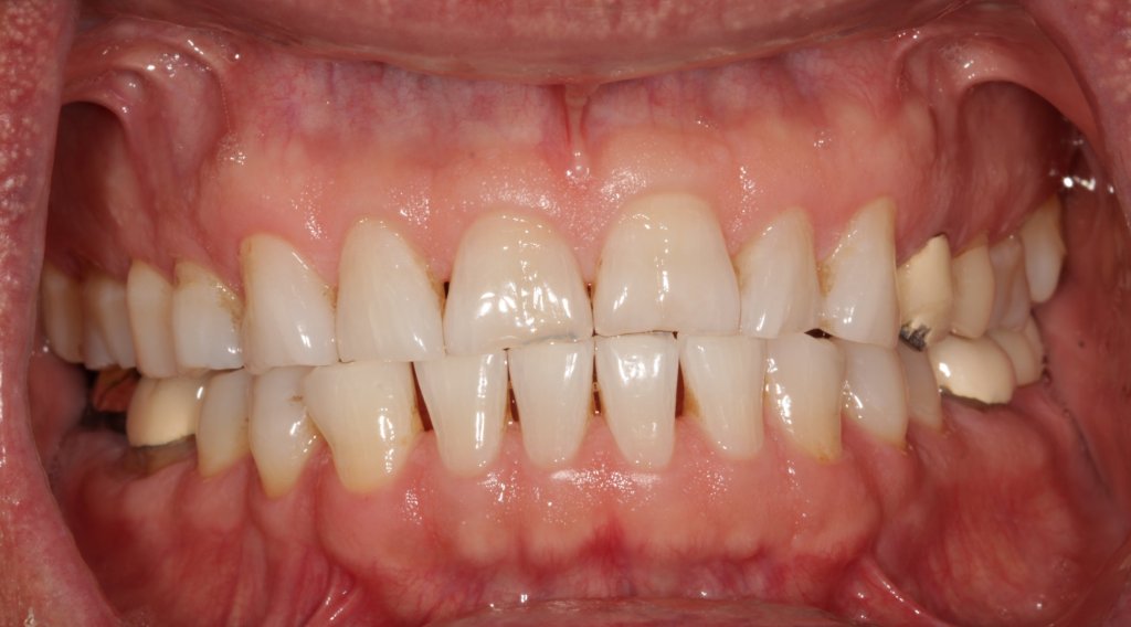 before Complete Maxillary Rehab (dental crowns on all upper teeth)