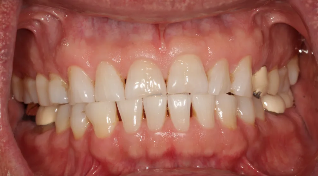 before Complete Maxillary Rehab (dental crowns on all upper teeth)