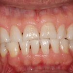 before Complete Maxillary Rehab (dental crowns on all upper teeth)