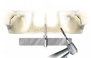 #1 Surgical procedure to place implants