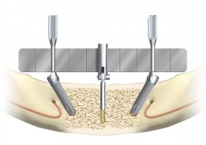 #2 Implants are surgically placed