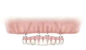 #3 Immediate load implant retained fixed bridge on the top