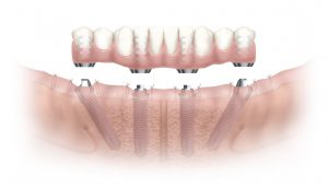 #4 Immediate load implant retained fixed bridge on the bottom