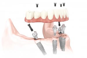 #5 Components used for new teeth in a day