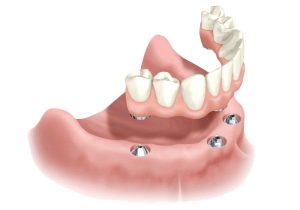 #6 Final teeth over implants