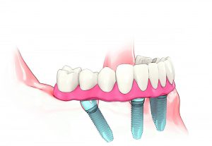 #7 Final placement of new teeth