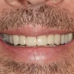 Before and After image