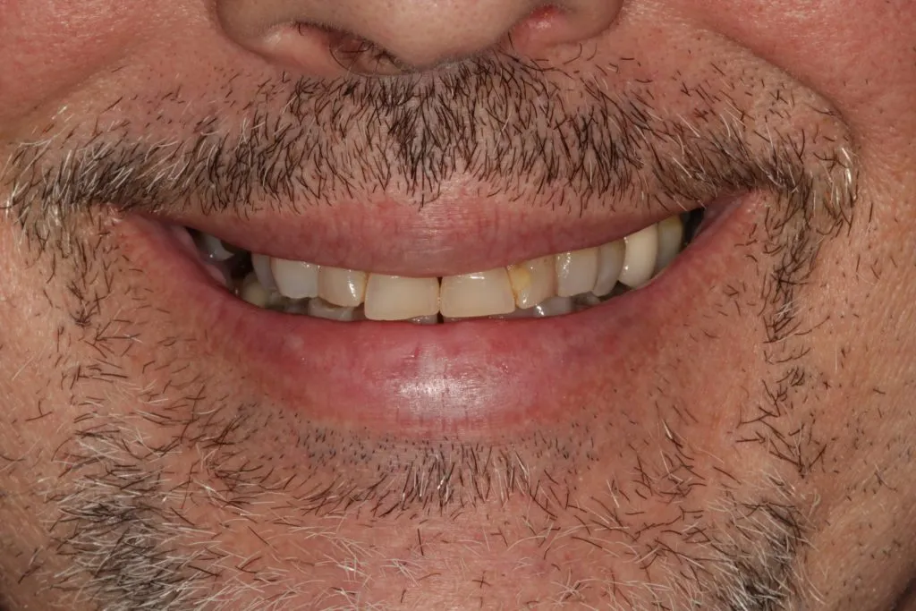 Before and After image