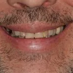 Before and After image