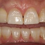 Before and After image